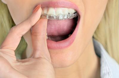 woman putting in clear aligner tray
