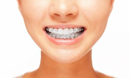 woman smiling with clear braces in galloway oh