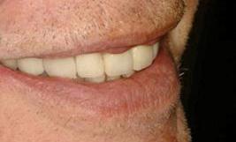 cosmetic dental bonding galloway oh