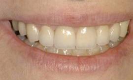 dental veneers galloway oh