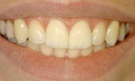 after cosmetic dentistry galloway oh
