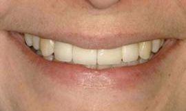 after porcelain veneers galloway oh