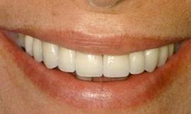 porcelain veneers galloway oh
