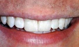 short term orthodontics and teeth whitening galloway oh