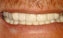 after cosmetic dentistry galloway oh