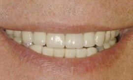 fixed discolored teeth galloway oh