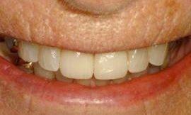 dental bonding galloway oh