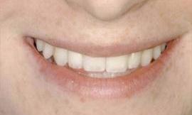 dental implant galloway oh l Galloway Smiles