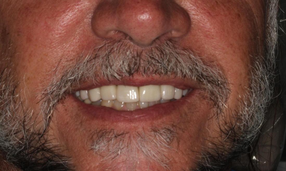 new dental crowns galloway oh