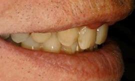 rounding of teeth galloway oh