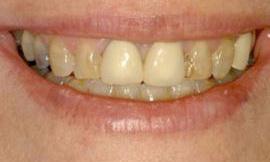 discolored teeth