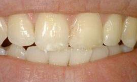 before cosmetic dentistry galloway oh