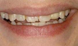 before porcelain veneers galloway oh