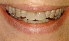 discolored chipped teeth galloway oh