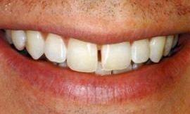 gap in smile galloway oh l Galloway Smiles