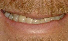 before cosmetic dentistry galloway oh