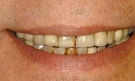discolored teeth galloway oh
