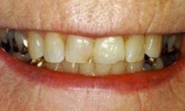 chipped tooth galloway oh