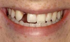 missing tooth galloway oh l Galloway Smiles in Grove City OH